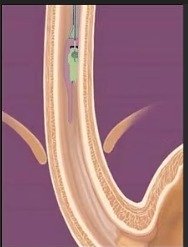 Registro de exposición al acido inalámbrico (capsula bravo)